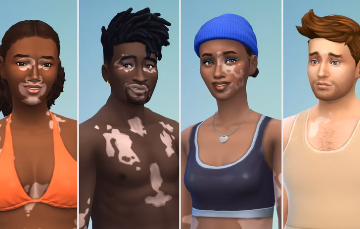 The Sims 4 implementa la Vitiligine